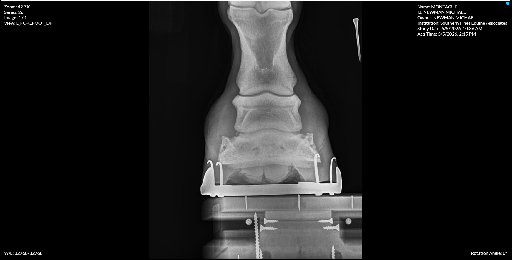 Left Forefoot DP